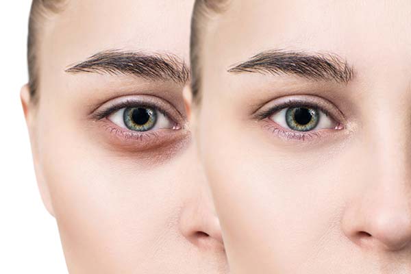 7 روش درمان گودی زیر چشم و سیاهی اطراف آن