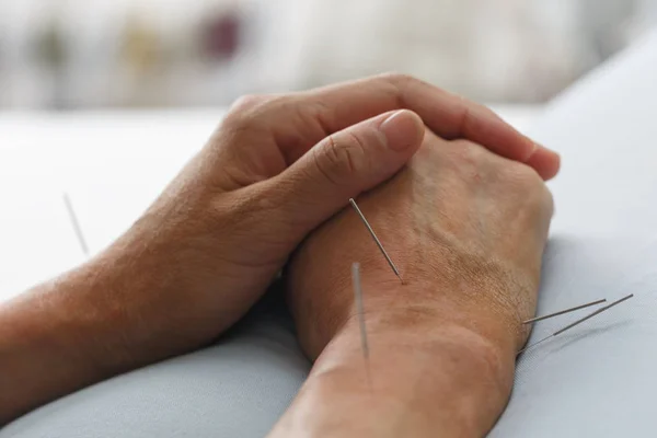 درمان درد انگشتان دست در طب سنتی با طب سوزنی