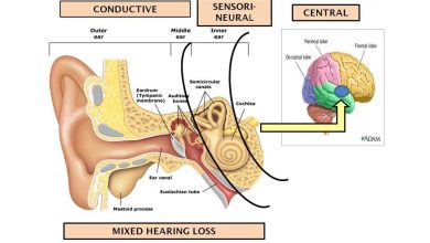کم شنوایی آمیخته چیست و روش درمان آن چگونه است؟