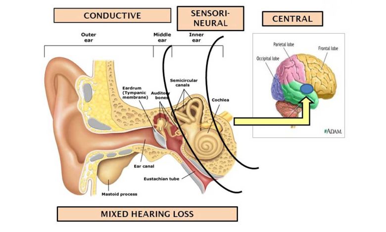 کم شنوایی آمیخته چیست و روش درمان آن چگونه است؟