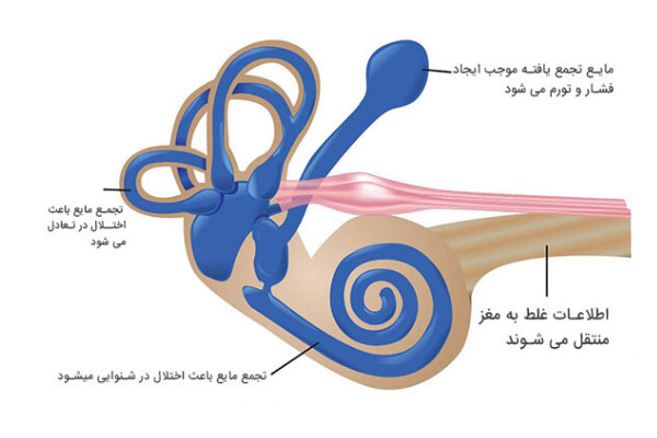 مریضی منیر (Meniere’s disease) علت گرفتگی گوش
