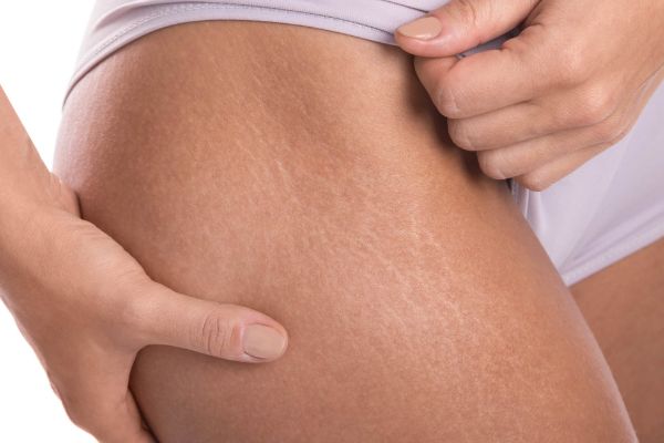 روش های درمان ترک های پوستی خانگی