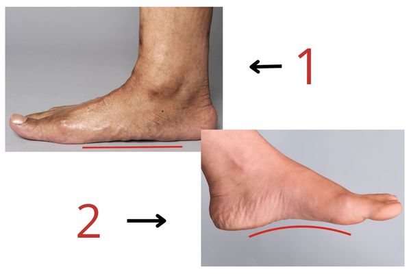  تشخیص کف پای صاف از چه طریقی انجام می شود؟