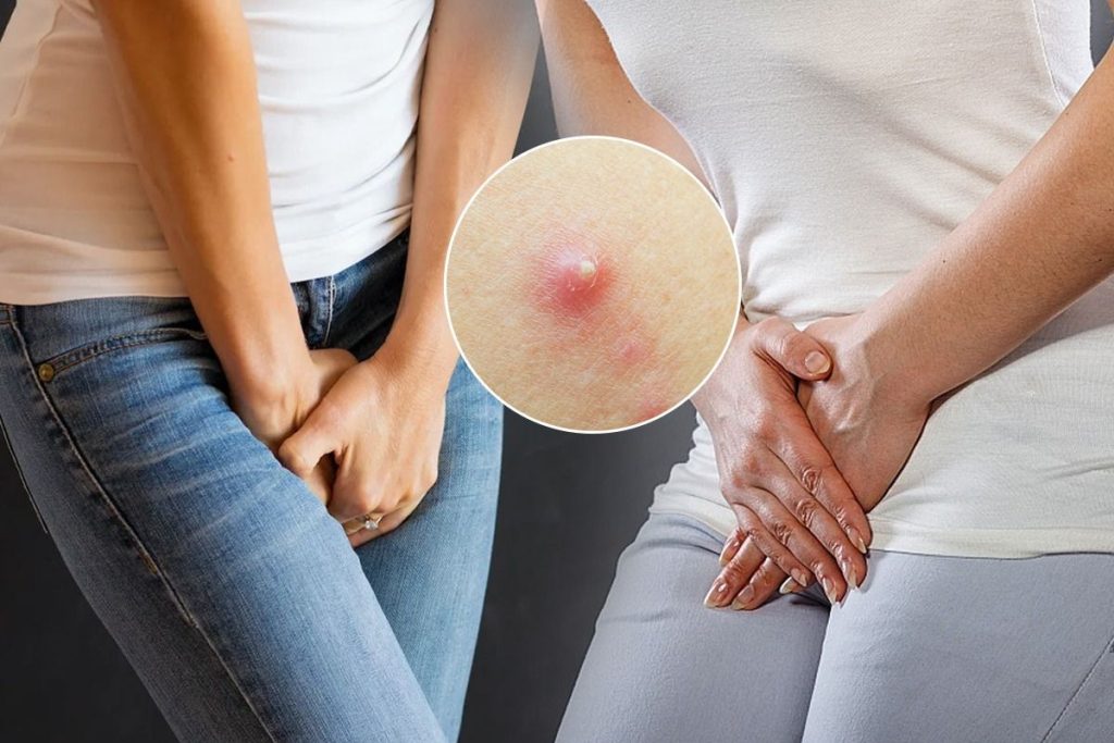 جوش ناحیه تناسلی زنان چیست و چگونه درمان می شود؟