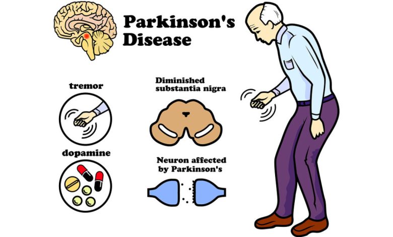 بیماری پارکینسون چیست و چه علائمی دارد؟