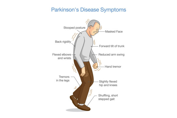 علائم بیماری پارکینسون چیست؟