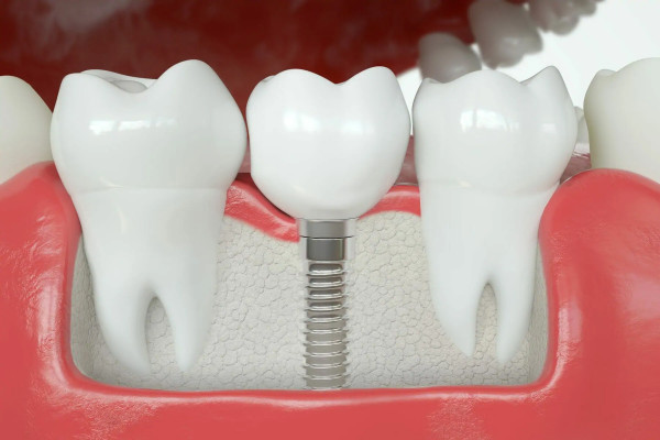ماندگاری ایمپلنت دندان چقدر است؟