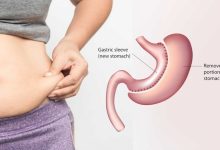 عمل اسلیو معده چیست و چه مزایایی دارد؟