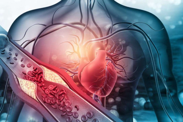 علت گرفتگی رگ قلب چیست؟