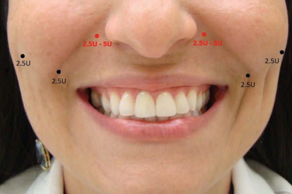 فواید درمان لبخند لثه ای با بوتاکس