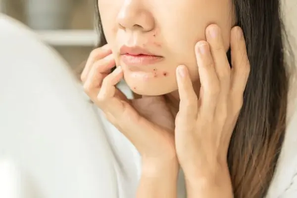 علت جوش چانه در طب سنتی